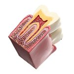 Extensive Caries Comparison Model (Large)