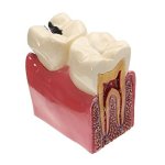 Extensive Caries Comparison Model (Large)