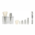Comprehensive Dental Implant Model with All Components