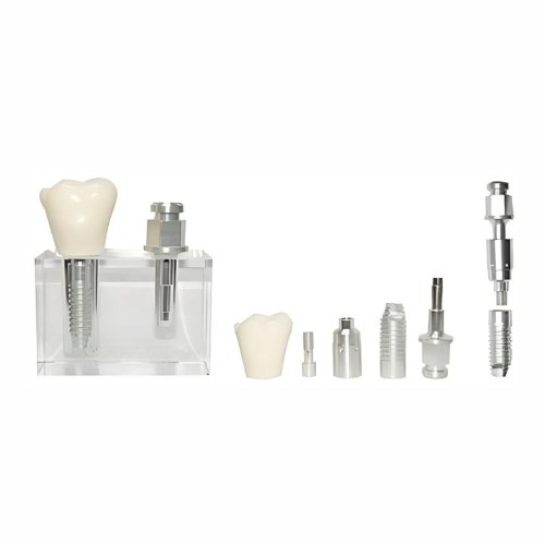 Comprehensive Dental Implant Model with All Components