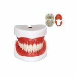 Complete Overdenture Implant model