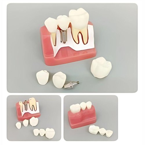 Implant Supported Bridge Model for Prosthetic Restoration