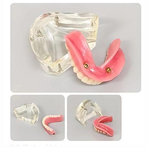 Overdenture Model with 2 Implants