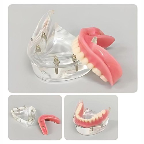 Overdenture Model with 4 Implants